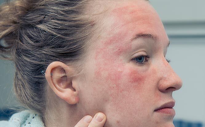 24604-eczema-on-face
