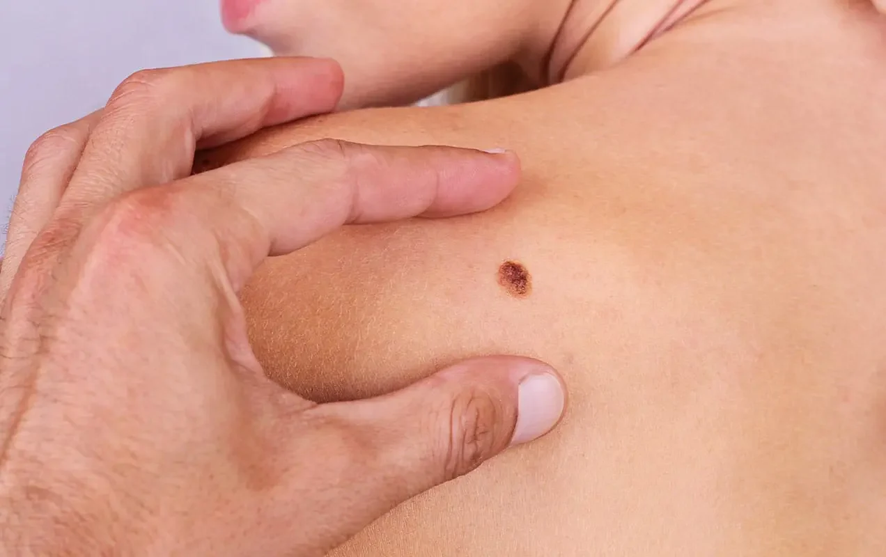 31-Tips-to-Consider-for-Skin-Cancer-Screening