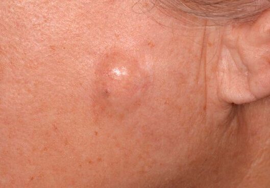 C0549632-Sebaceous_cyst_copy.original.max-600×600
