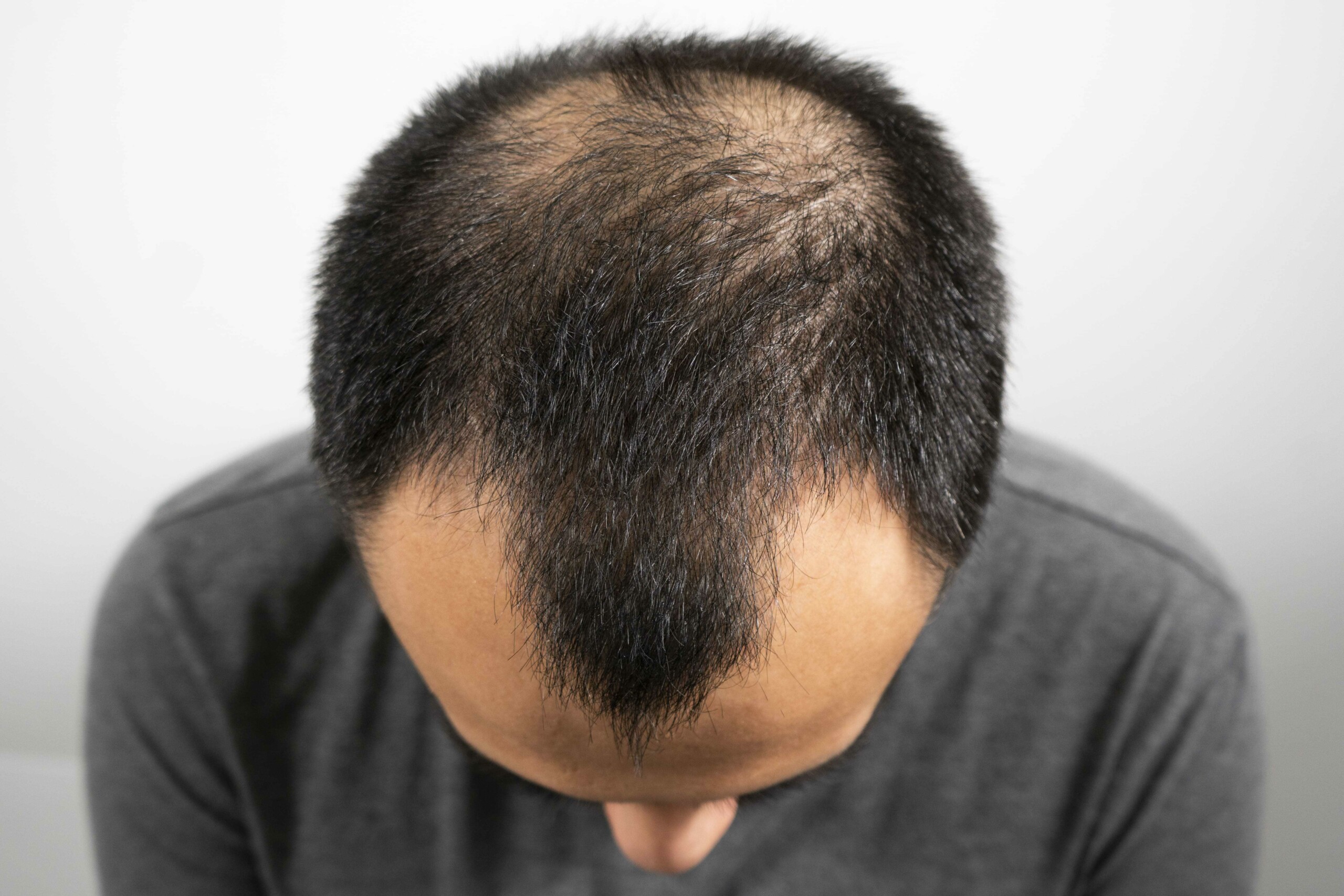 HairScience_Man-with-androgenetic-alopecia-scaled