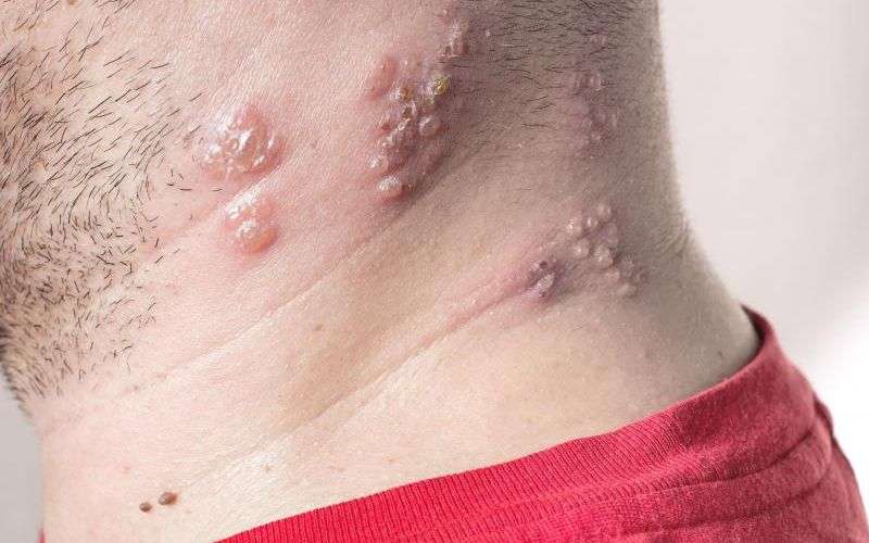 How-to-cure-lichen-planus-1