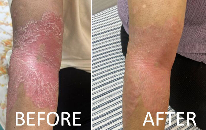 Psoriasis-Treatment