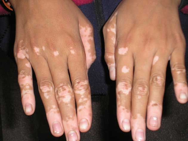 VITILIGO-SURGERY-GRAFTING-MELANOTRANSFER