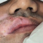 “Vitiligo treatment with melanocyte transplantation in Mira Road Mumbai”