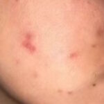 Dermatologist explaining why acne persists despite treatment”
