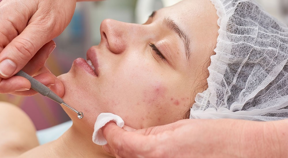 acne-banner