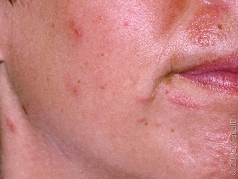 allergic_reaction_rash_219200