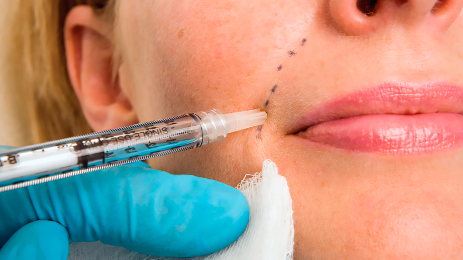 dermal_fillers_1600x900