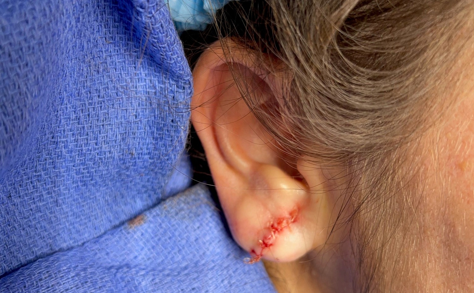 earlobe-repair