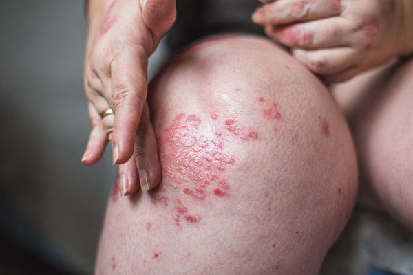 Applying An Emollient To Dry Flaky Skin As In The Treatment Of P
