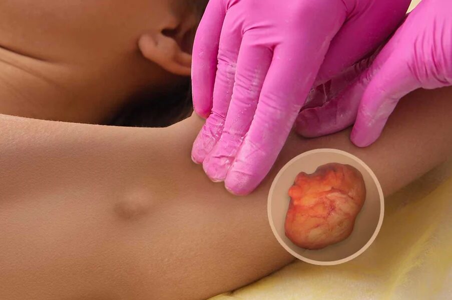 lipoma-surgery