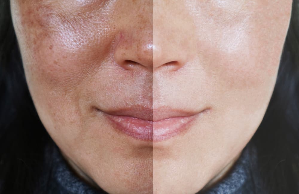melasma-skin