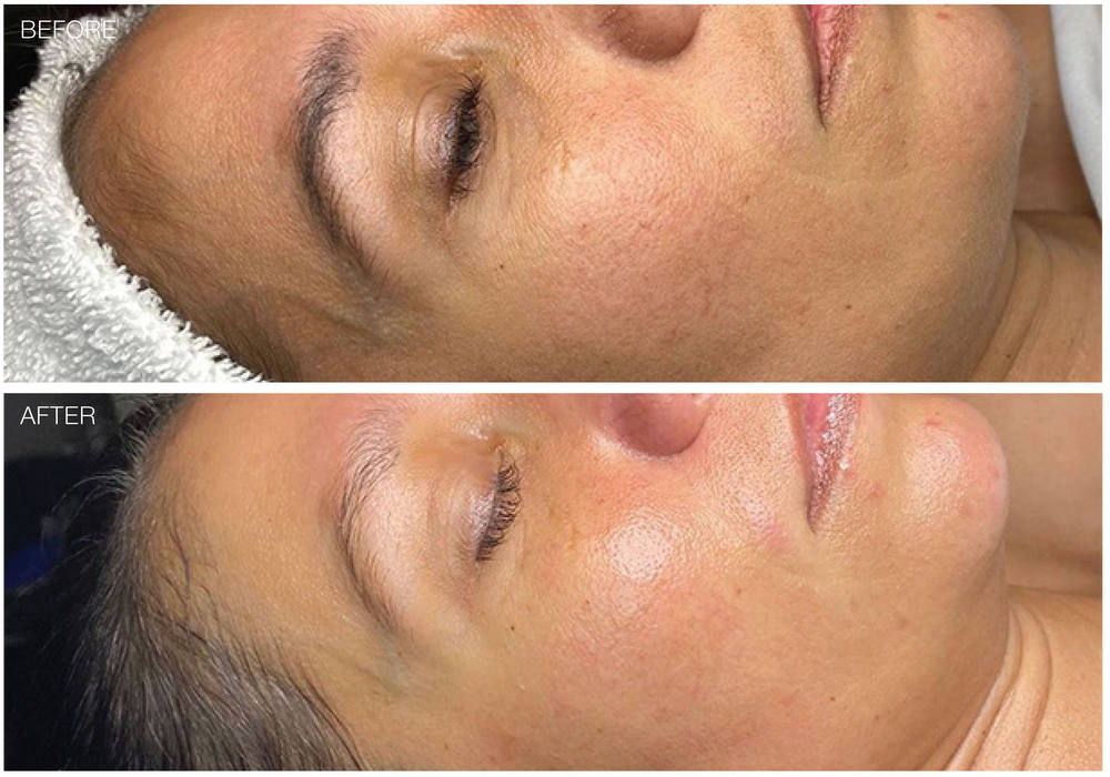 microdermabrasion-1