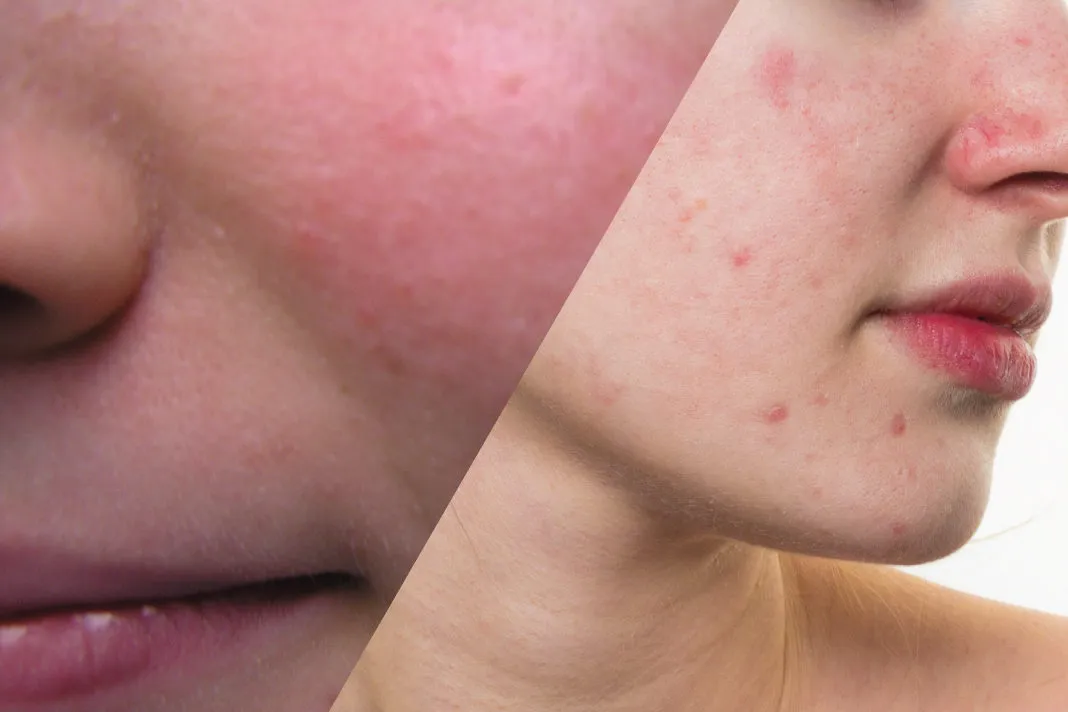 rosacea_acne-1068×712