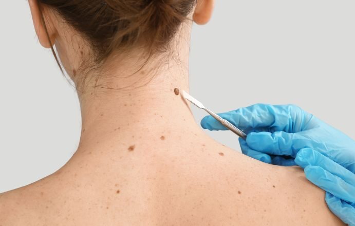 skin-tag-removal