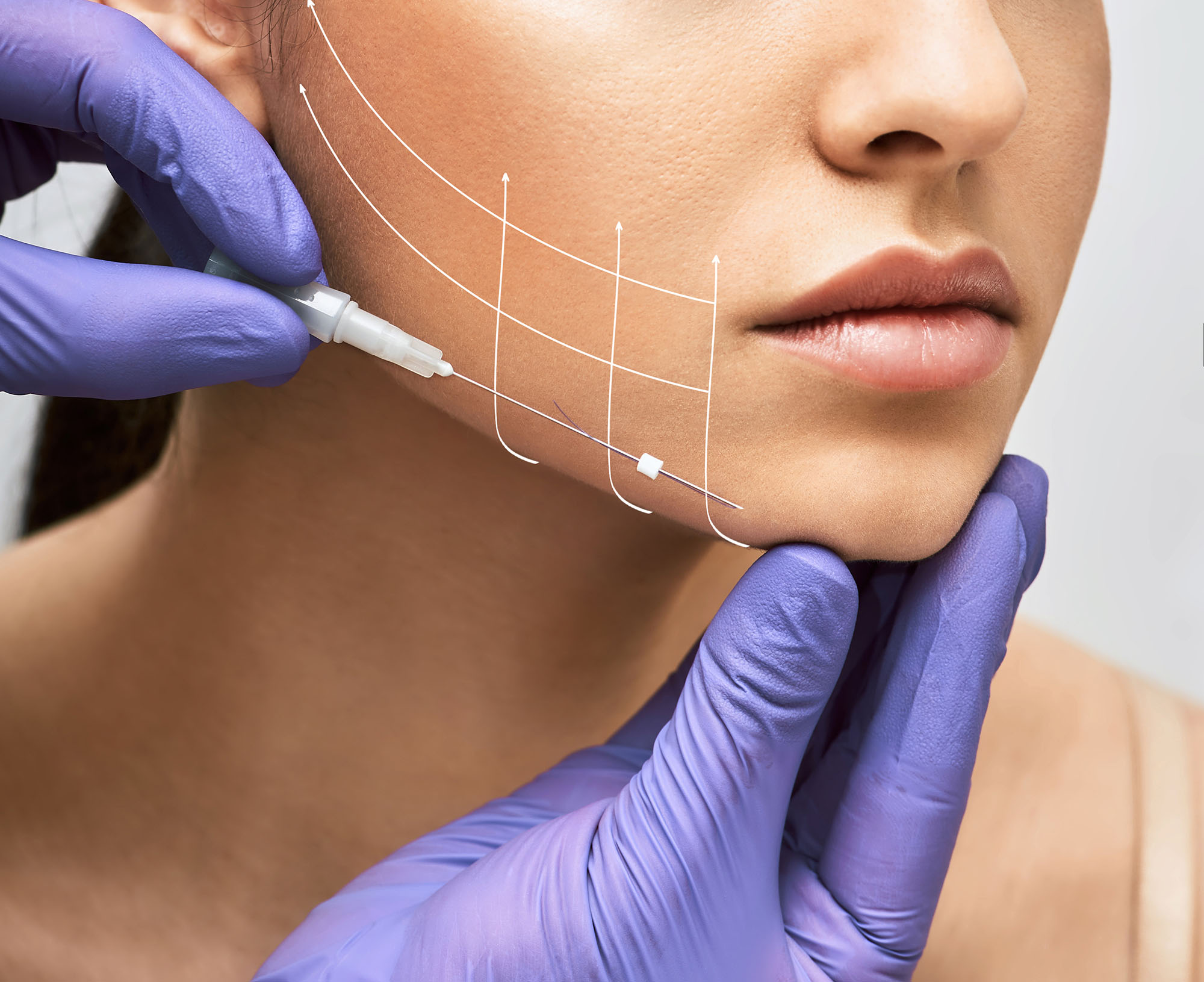 Facial,Lifting,Thread.,Thread,Facelift,With,Arrows,On,Face,For