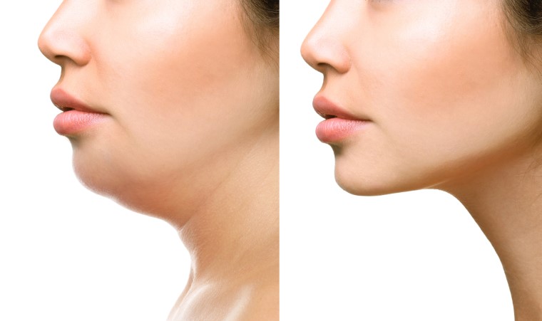 Part,Of,Face,,Woman,With,The,Double,And,Perfect,Chin