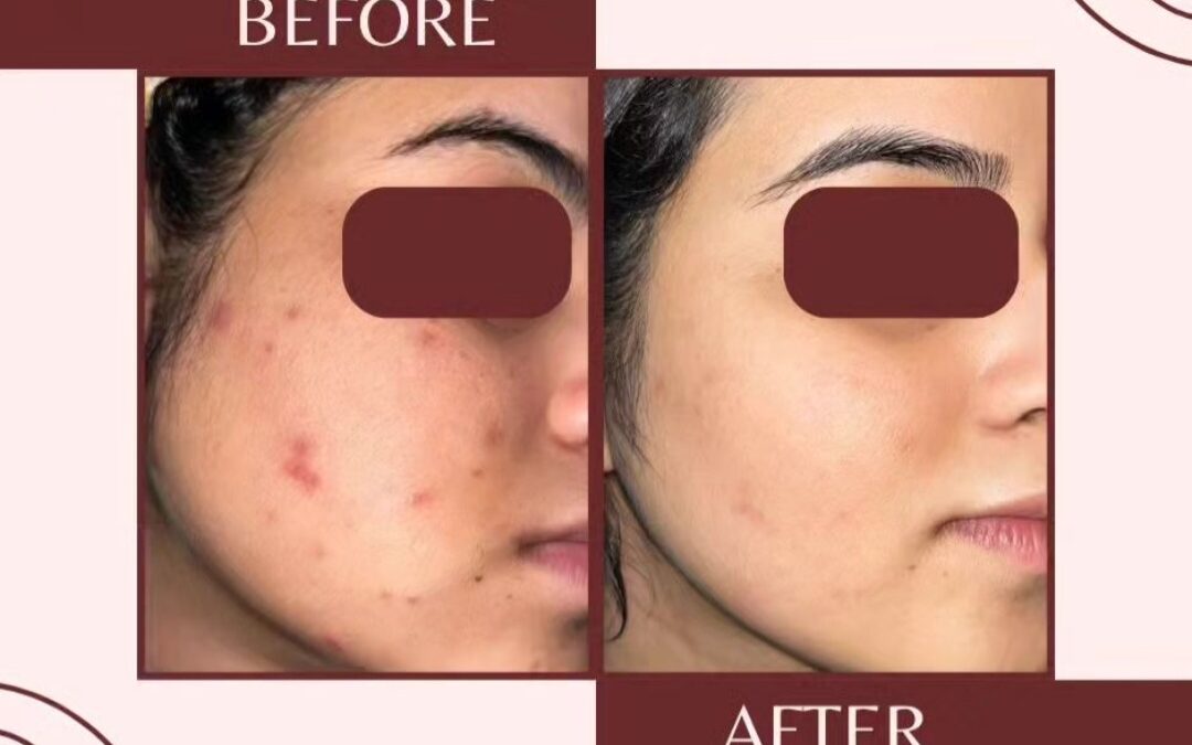 best dermatologist in mira road for acne scar treatment