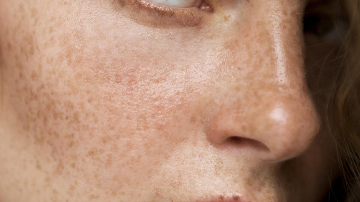 best dermatologist in mira road for pigmentation and melasma