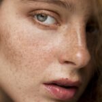 best dermatologist in mira road for pigmentation and melasma