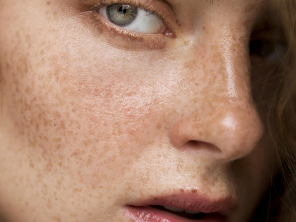 best dermatologist in mira road for pigmentation and melasma
