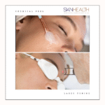 A woman with her face masked during a laser treatment session, highlighting the benefits of laser toning versus chemical peels.