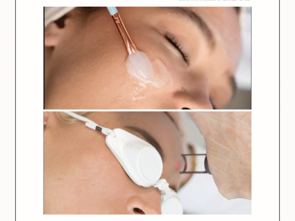 A woman with her face masked during a laser treatment session, highlighting the benefits of laser toning versus chemical peels.