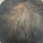 Hair loss continuing even after treatment explained by dermatologist