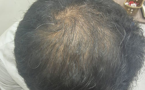Hair loss continuing even after treatment explained by dermatologist