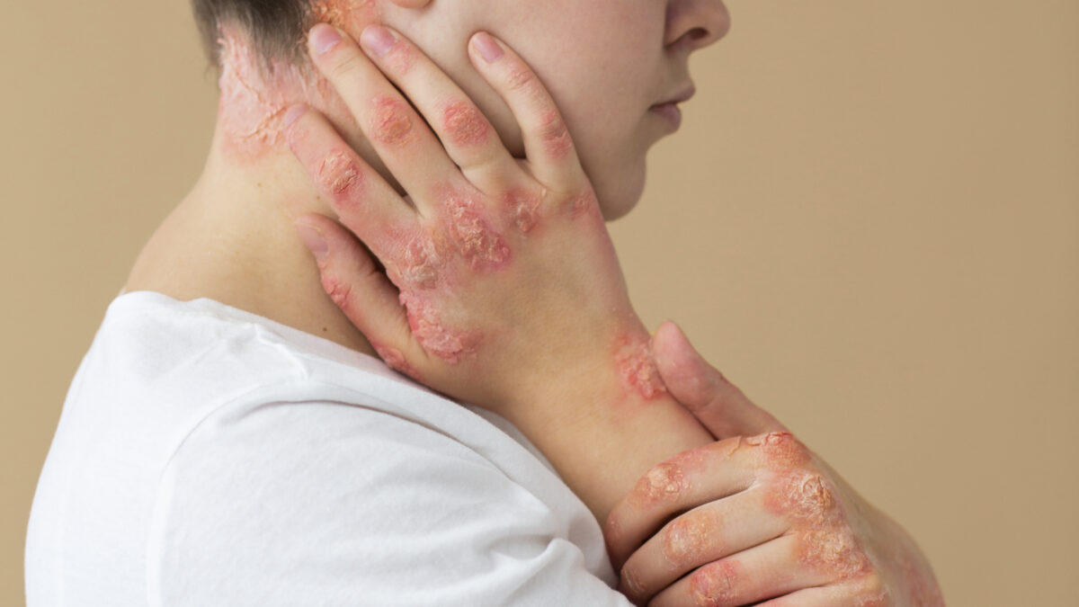 Eczema flare-ups causing red, itchy skin explained by a dermatologist in Mira Road and Mumbai