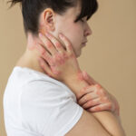 Eczema flare-ups causing red, itchy skin explained by a dermatologist in Mira Road and Mumbai