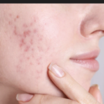 CO2 fractional laser acne scar treatment in Mira Road performed by dermatologist