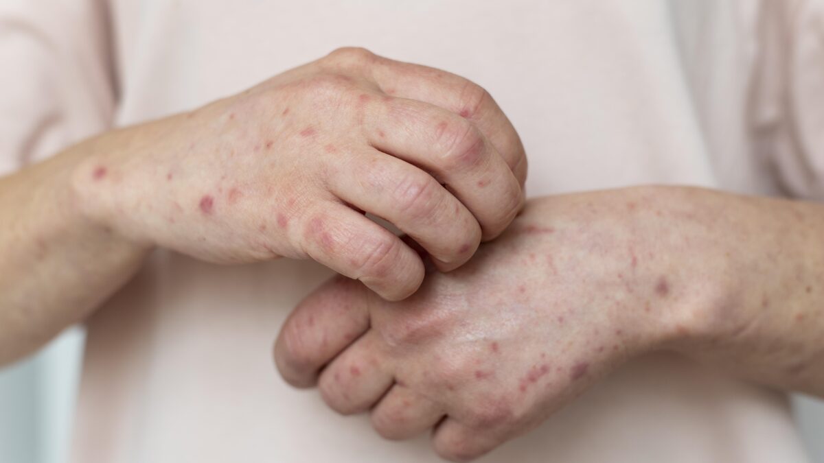 “Food allergy skin rash treatment by dermatologist in Mira Road Mumbai”