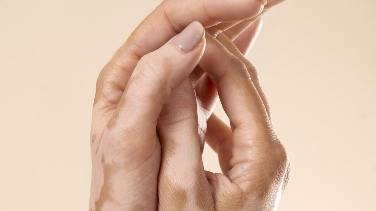 Vitiligo myths explained by vitiligo specialist in Mira Road Mumbai