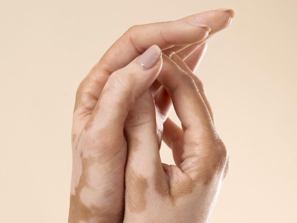 Vitiligo myths explained by vitiligo specialist in Mira Road Mumbai