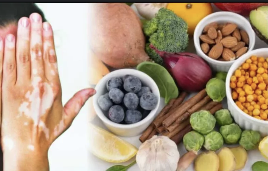 Vitiligo diet guide explained by vitiligo specialist in Mira Road Mumbai