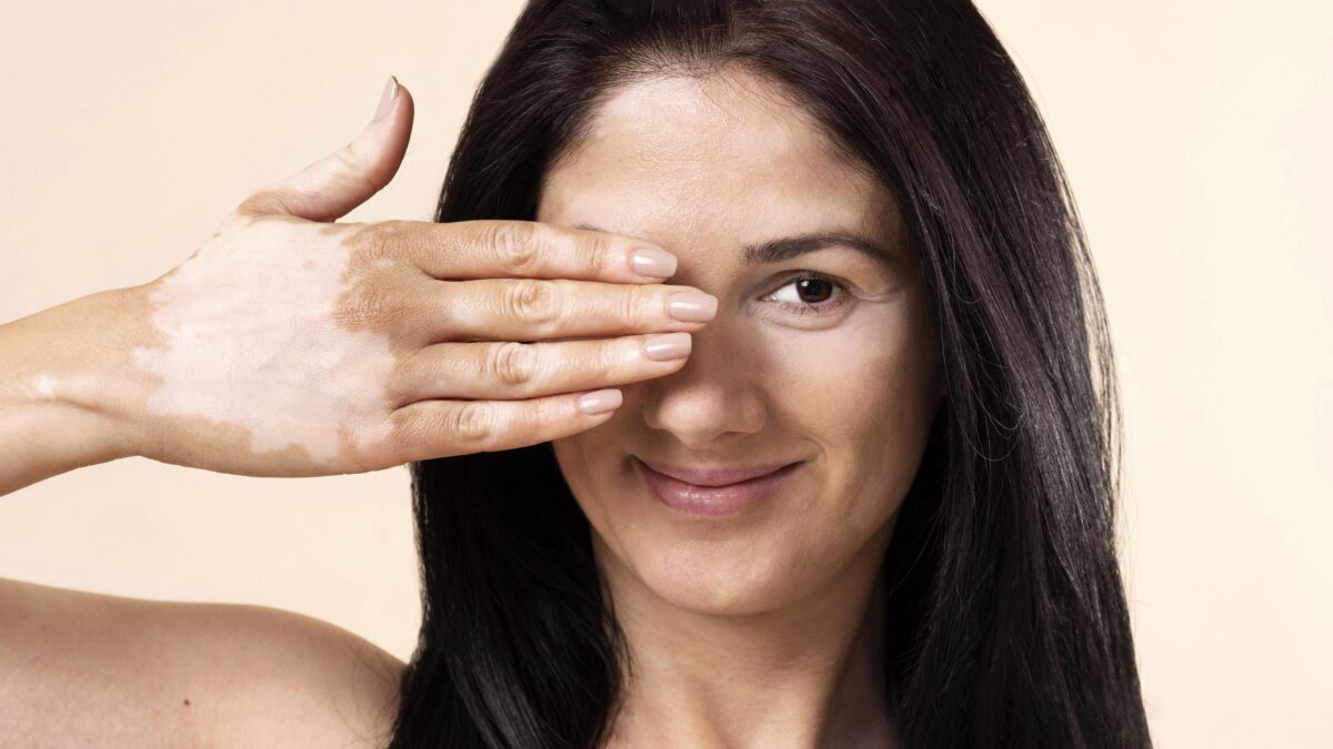 Early vitiligo treatment by vitiligo specialist in Mira Road Mumbai using advanced dermatology care