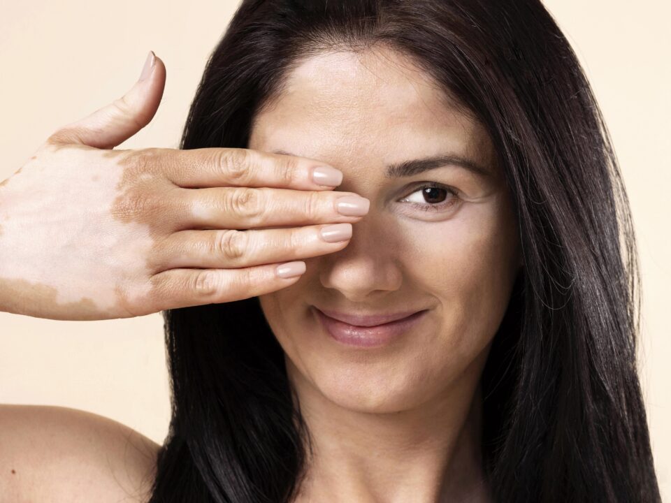 Early vitiligo treatment by vitiligo specialist in Mira Road Mumbai using advanced dermatology care