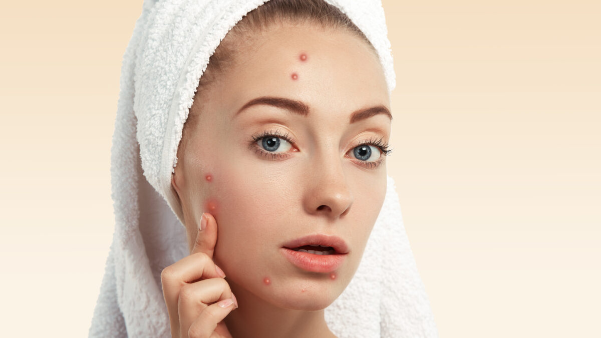 Woman experiencing hormonal acne before her menstrual period