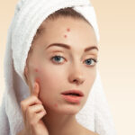 Woman experiencing hormonal acne before her menstrual period