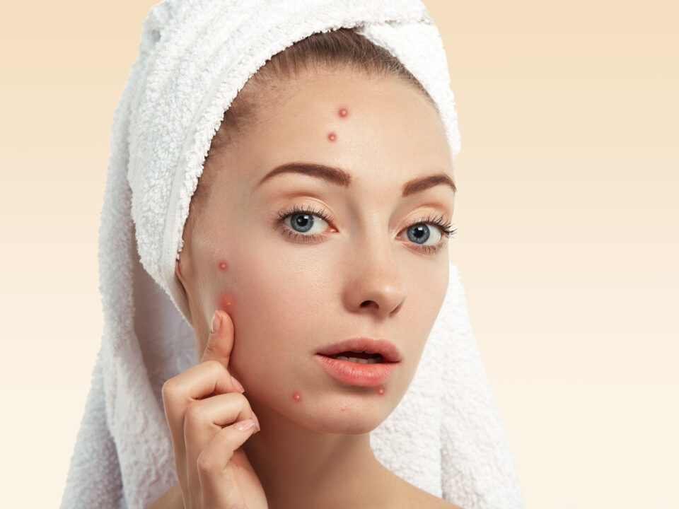 Woman experiencing hormonal acne before her menstrual period
