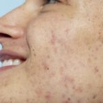 Dermatologist evaluating facial pigmentation