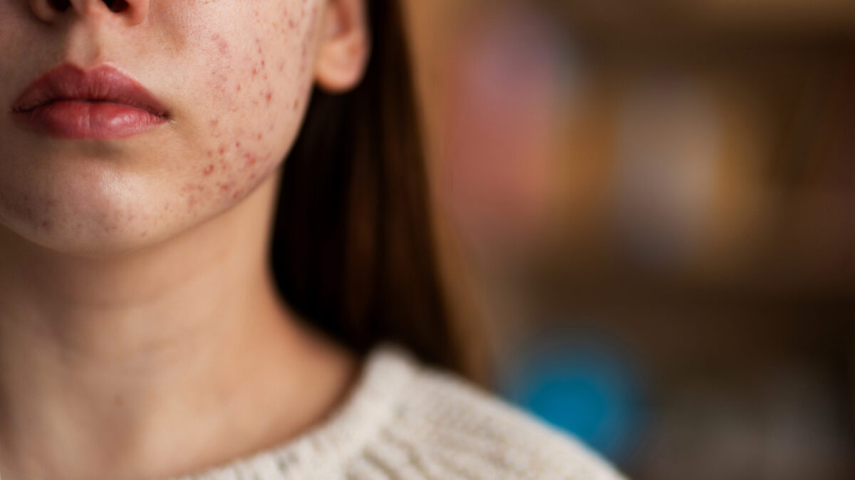 Hormonal acne signs and treatment in Mira Road