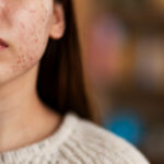 Hormonal acne signs and treatment in Mira Road