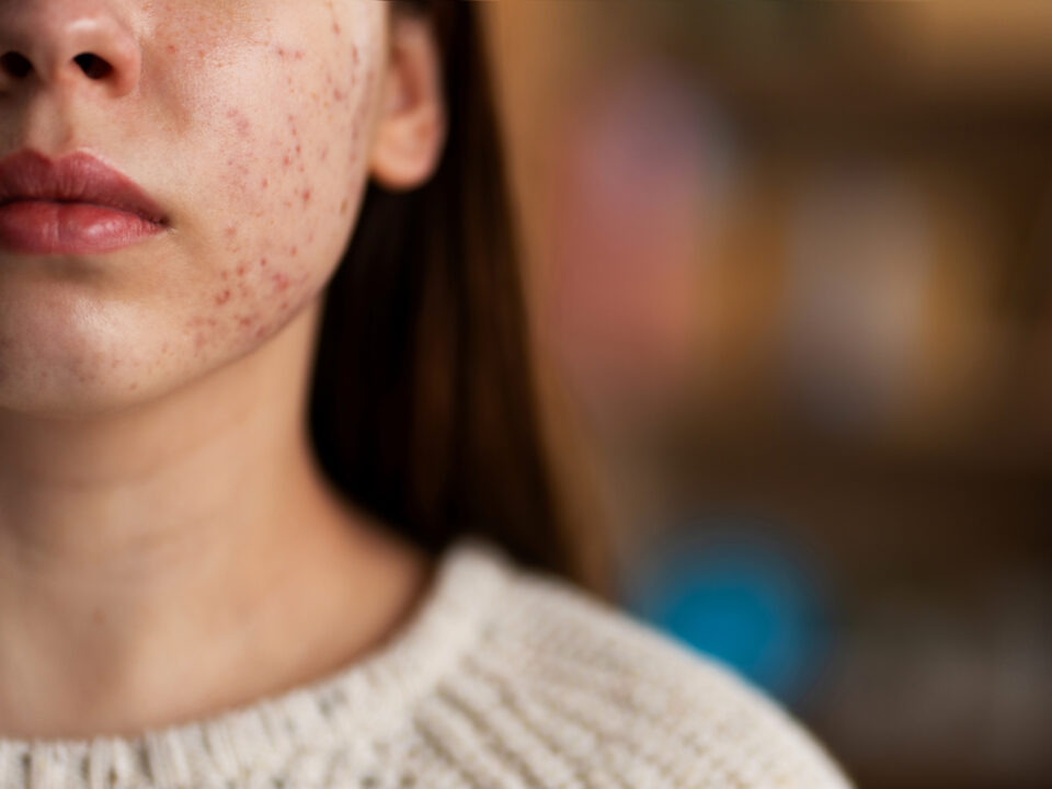 Hormonal acne signs and treatment in Mira Road