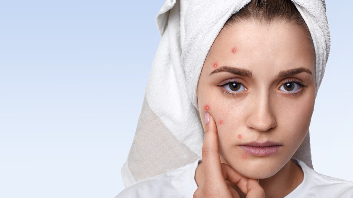 Dermatologist examining acne scars during acne scar treatment in Mira Road Mumbai