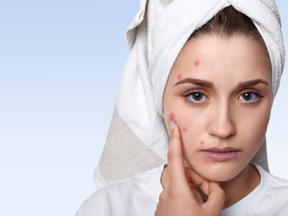 Dermatologist examining acne scars during acne scar treatment in Mira Road Mumbai