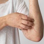 Urticaria hives on skin requiring dermatology evaluation
