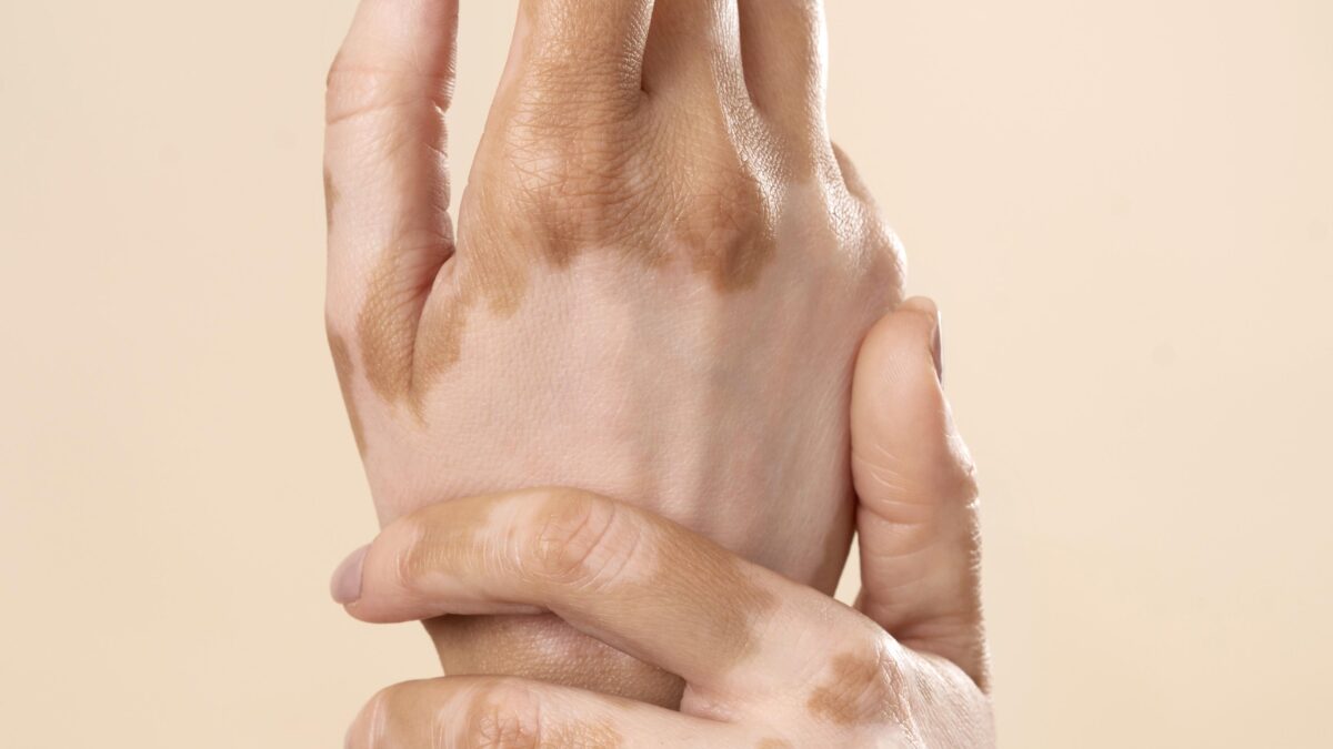 Dermatologist explaining vitiligo treatment options in Mira Road Mumbai