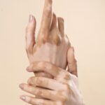 Dermatologist explaining vitiligo treatment options in Mira Road Mumbai